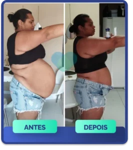 Mulher sorrindo, antes e depois da transformação corporal com Ozenvitta, exibindo a grande perda de peso abdominal.