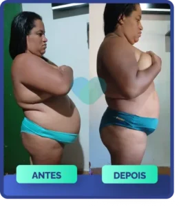 Mulher, antes e depois, com notável redução da gordura abdominal e medidas de cintura, resultado do uso de Ozenvitta.